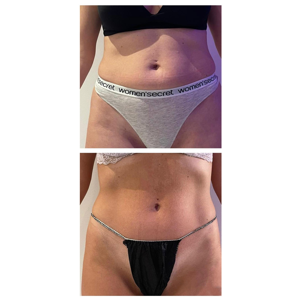 Adipologie-corporal_Antes-y-despues-4