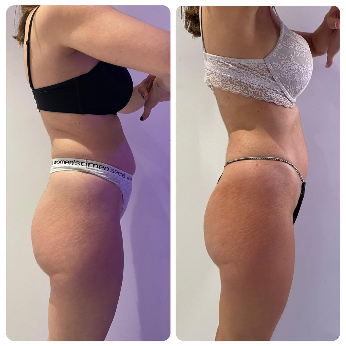 Adipologie-corporal_Antes-y-despues-5