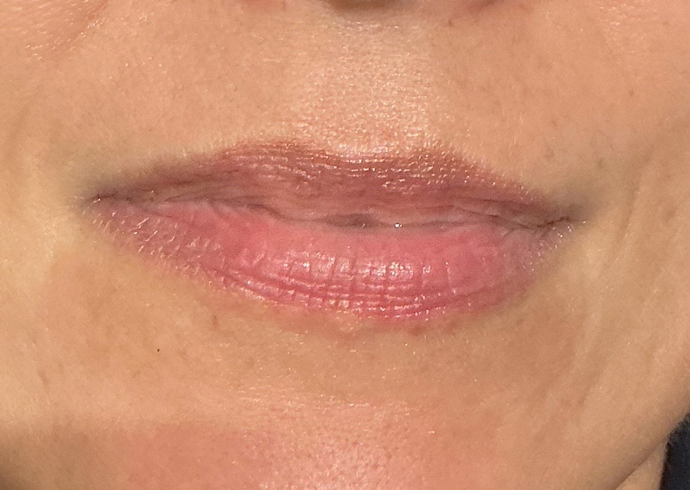 Antes,-frontal_Tratamientos-de-labios_Ollie-clinic Antes,-frontal_Tratamientos-de-labios_Ollie-clinic