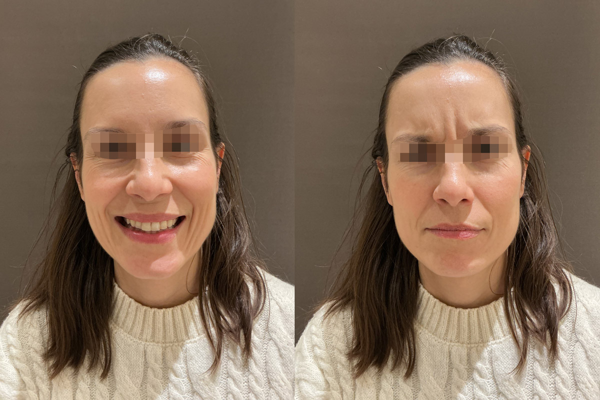 Neuromoduladores_Antes Neuromoduladores_Antes