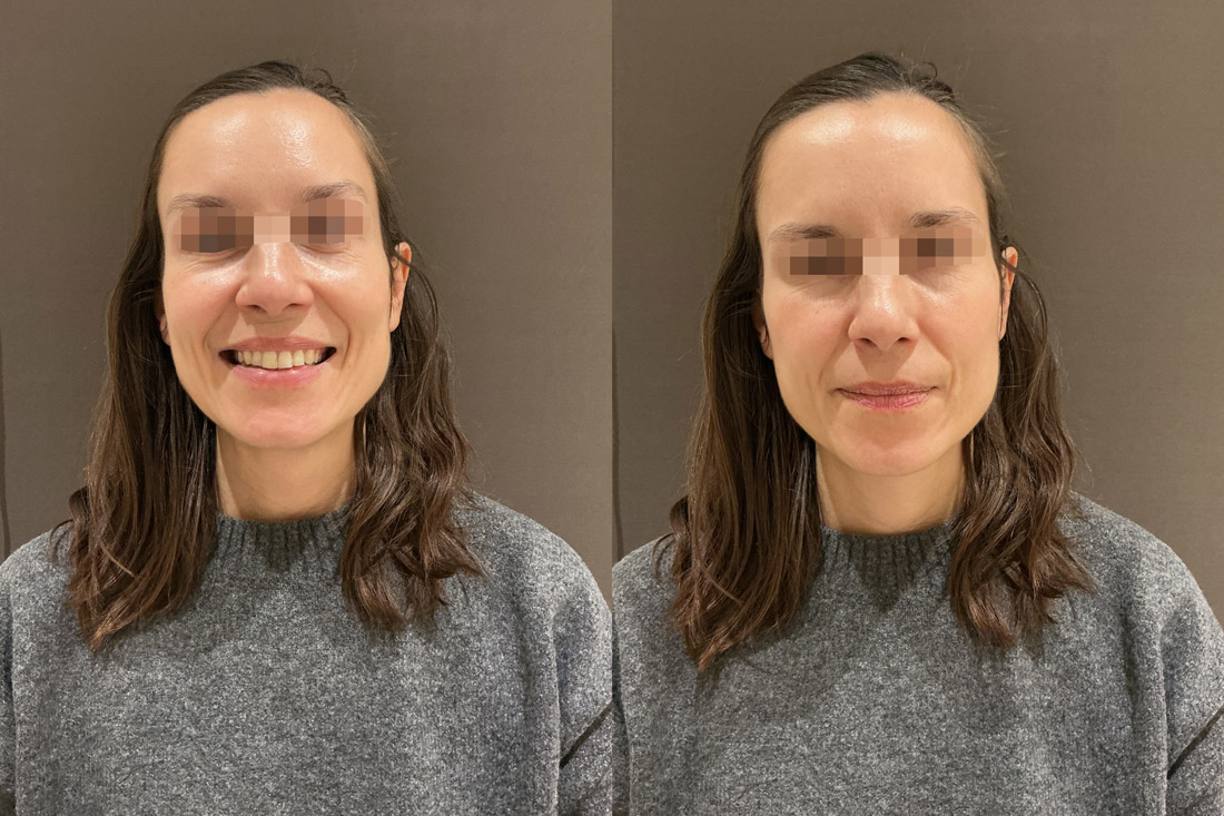 Neuromoduladores_Despues