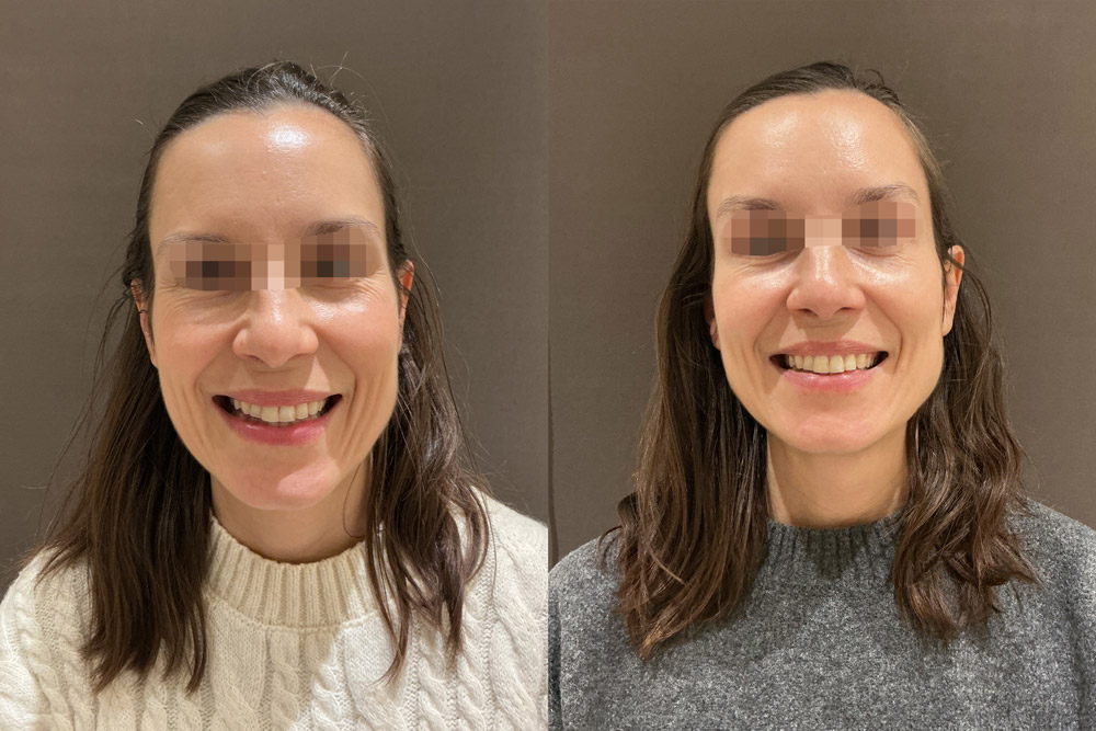 Toxina-botulinica_Antes-y-despues-01