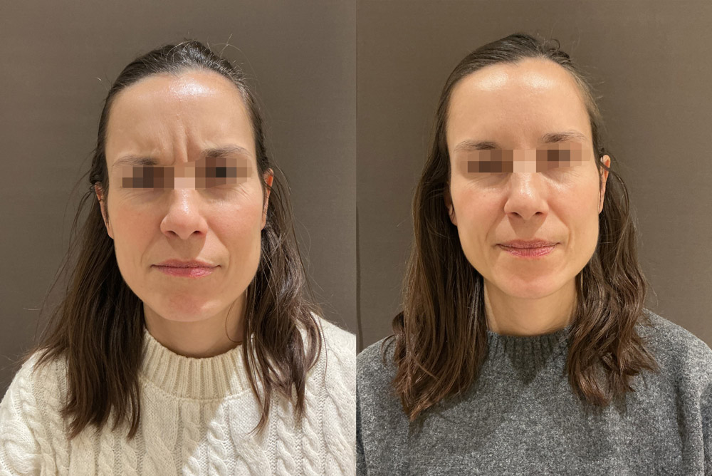 Toxina-botulinica_Antes-y-despues-02