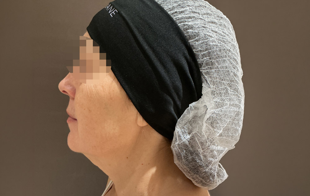 Adipologie-facial-antes