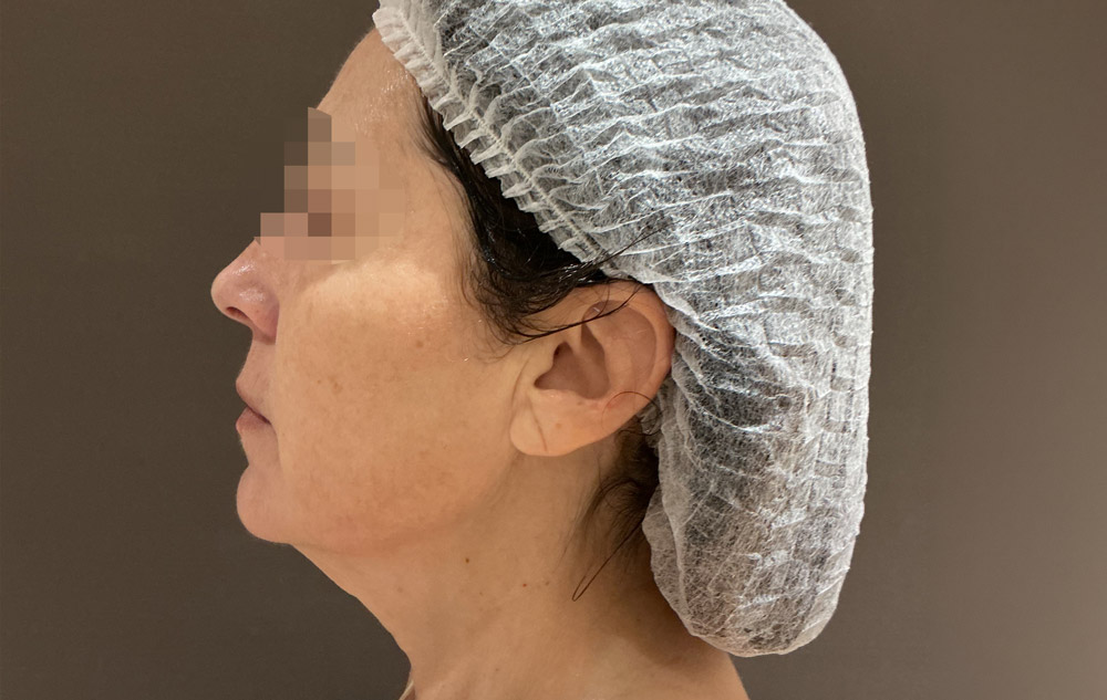 Adipologie-facial-despues