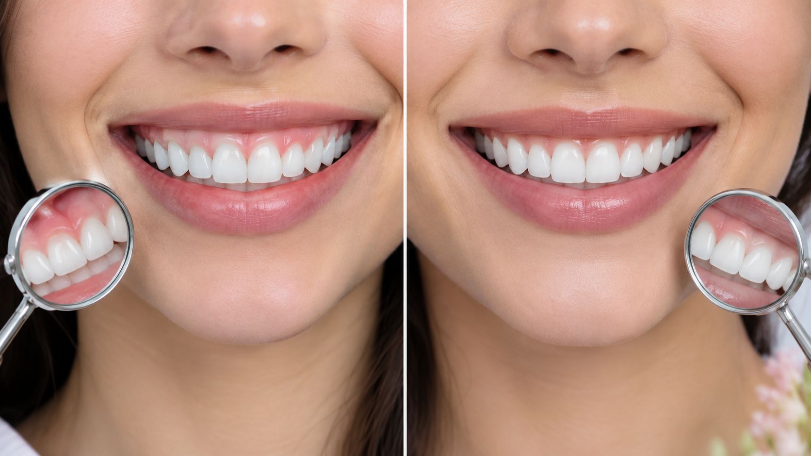 Sonrisa gingival corrección guía de tratamientos completos