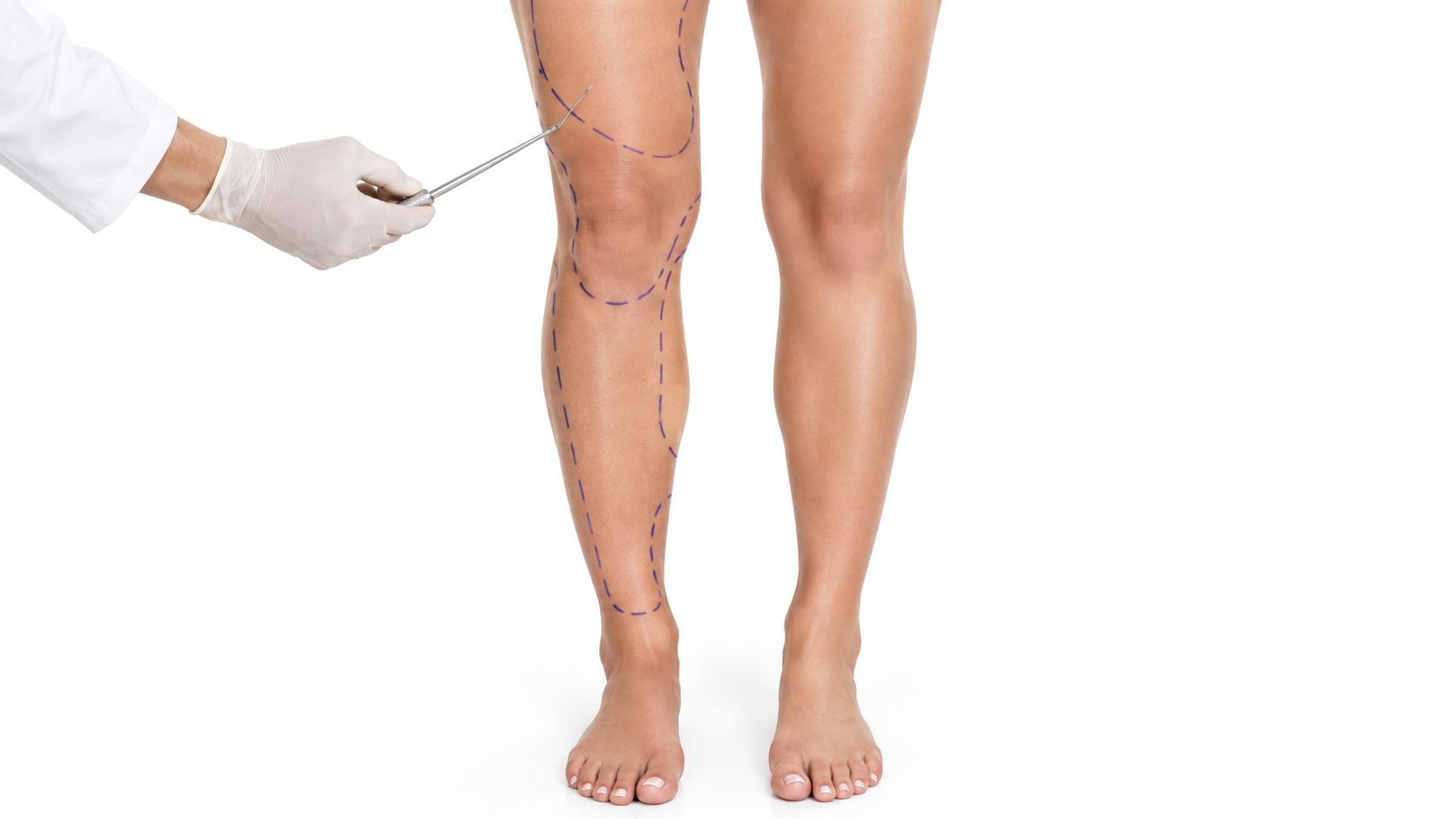 Lipoescultura piernas