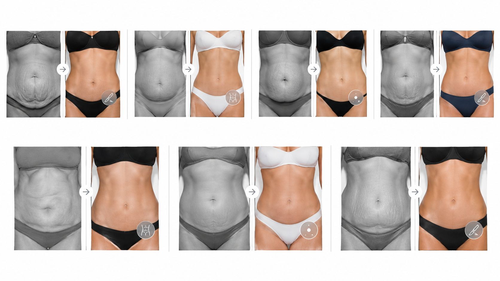 Abdominoplastia fotos: 7 casos antes y después